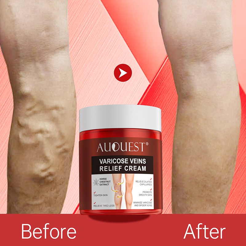 AUQUEST Varicose Veins Relief Cream Vasculitis Spider Pain Relief Ointment Medical Plaster Body Care 80g