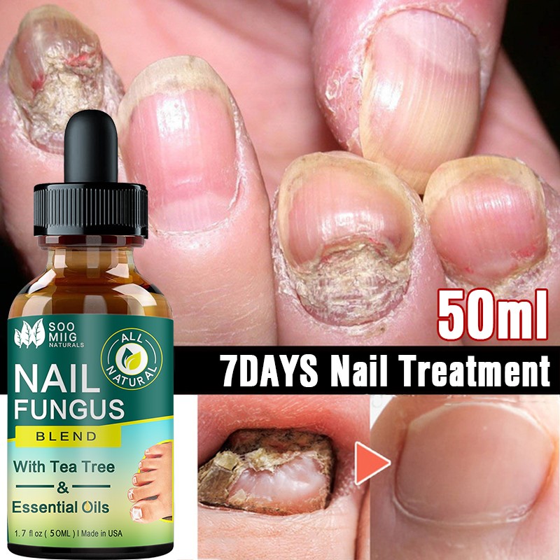 Nail Fungus Treatment Feet Care Nail Essence Repair Foot Toe Nail Fungus Removal Gel Anti Infection Paronychia Onychomycosis