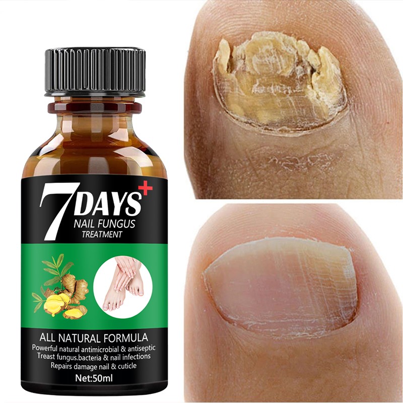 Nail Repair Serum Nail Fungal Treatment Serum Toenail Fungus Treatment Device Antifungal Toe Fungus Treatment Foot Repair Care