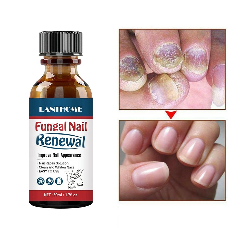 Fungal Nail Treatment Serum Onychomycosis Paronychia Anti-Fungal Nail Infection Herbal Toe Fungus Foot Repair Essence Care 50ml