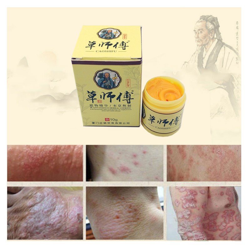 Psoriasis Cream 10g Chinese Herbal Ointment Psoriasis Ointment 7g Antibacterial Dermatitis Ointment From Caoshifu Psoriasis