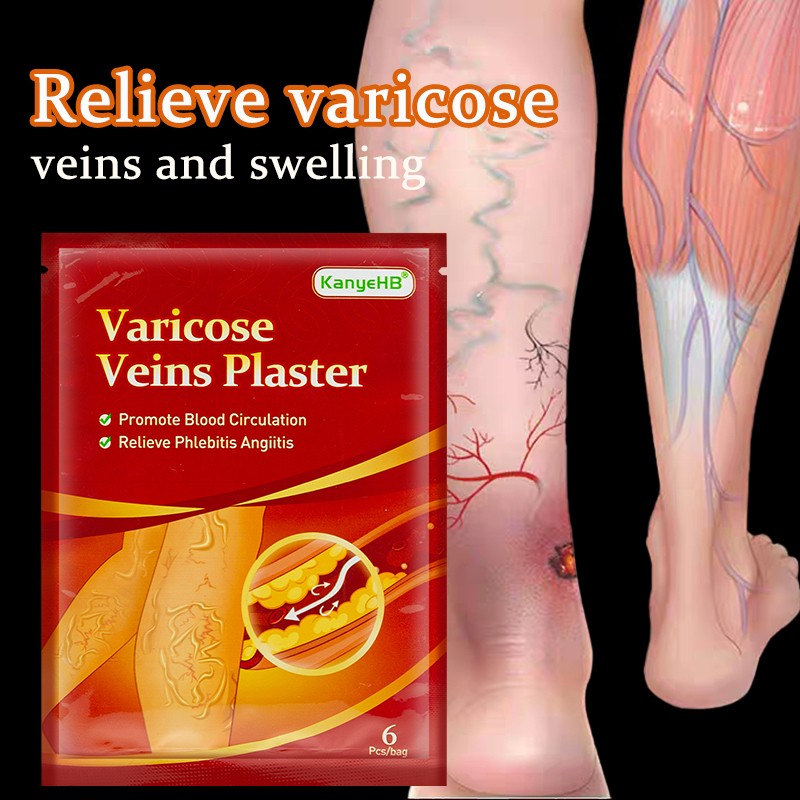 6pcs Varicose Veins Treatment Chinese Herbal Medicine Removal Phlebitis Vasculitis Spider Leg Veins Pain Plaster