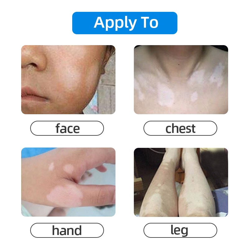 Chinese Medical Vitiligo Antibacterial Hand Spray White Spot Repair Liquid Foot Disease Leukoplakia Promote Melanin