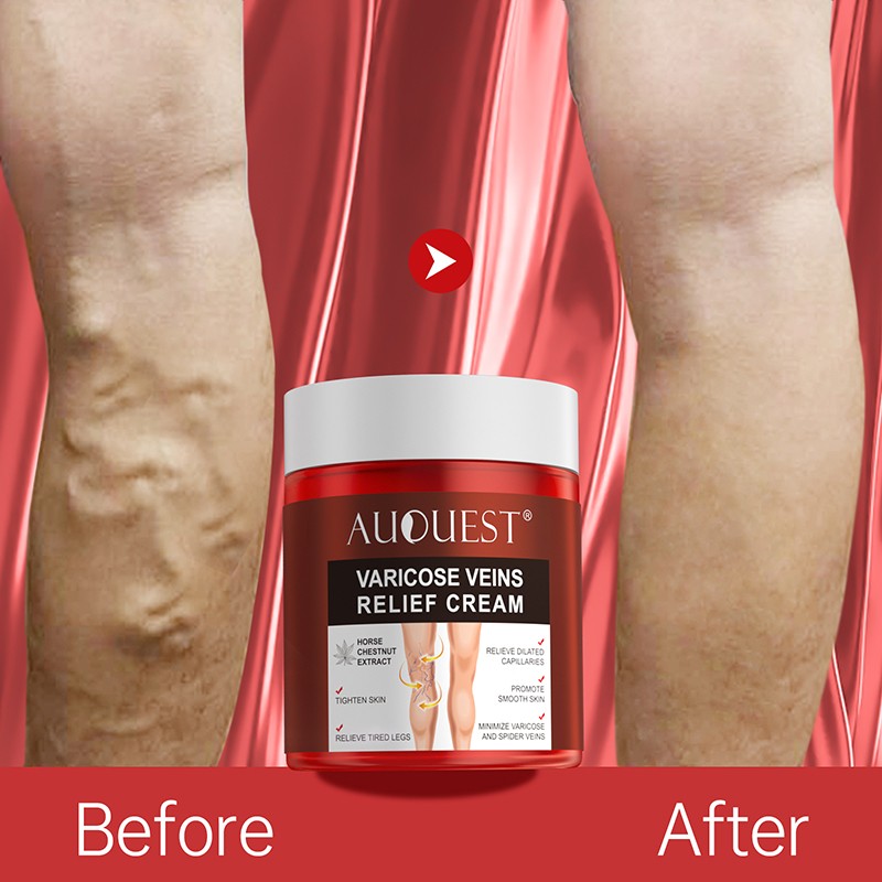 AUQUEST Varicose Veins Treatment Cream Relieve Fatigue Legs Dilatation Inflammation Felipe Vasculitis Spider Pain Relief Ointment Body Care 80g