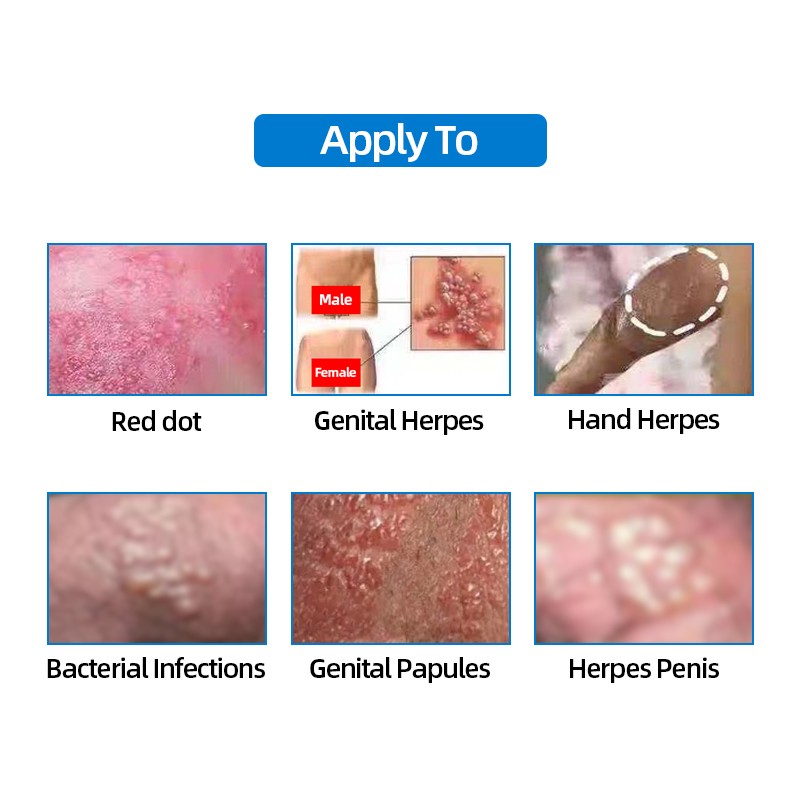 STD علاج كريم العلاج الطبي لؤلؤي حطاطات القضيب إزالة الدواء مرهم الأمراض التناسلية التهاب البلانين الهربس التناسلي