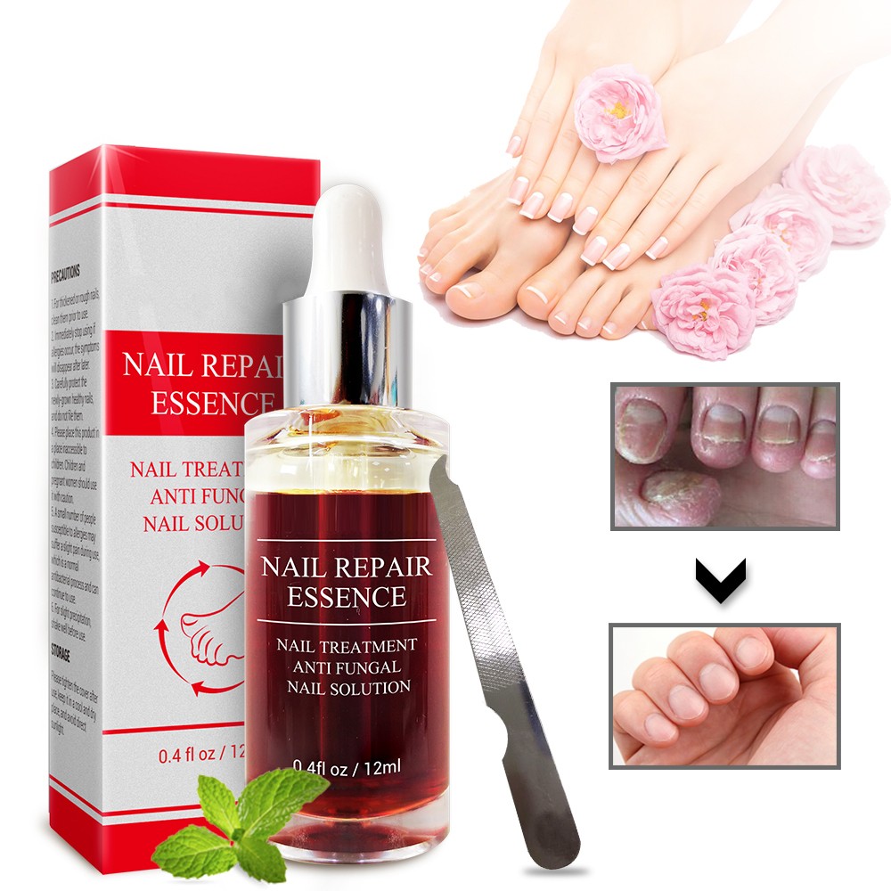 LANBENA - Fungus repair serum, nail care treatment, anti-infective gel, paronychia, onychomycosis