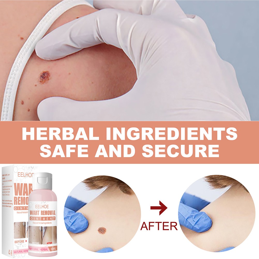 Skin Tag Wart Removal Against Mole Quick Removal Kit Papillary Treatment Natural Herbal Anti Verruca Non Irritant Non Toxic