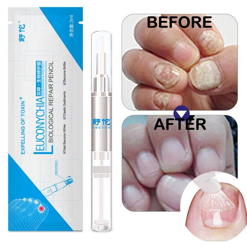 3ml Nail Repair Liquid Pen With Brush Cute Anti Fungus Remover Onychomycosis Paronychia Foot Nail Fungus For Nails Manicure