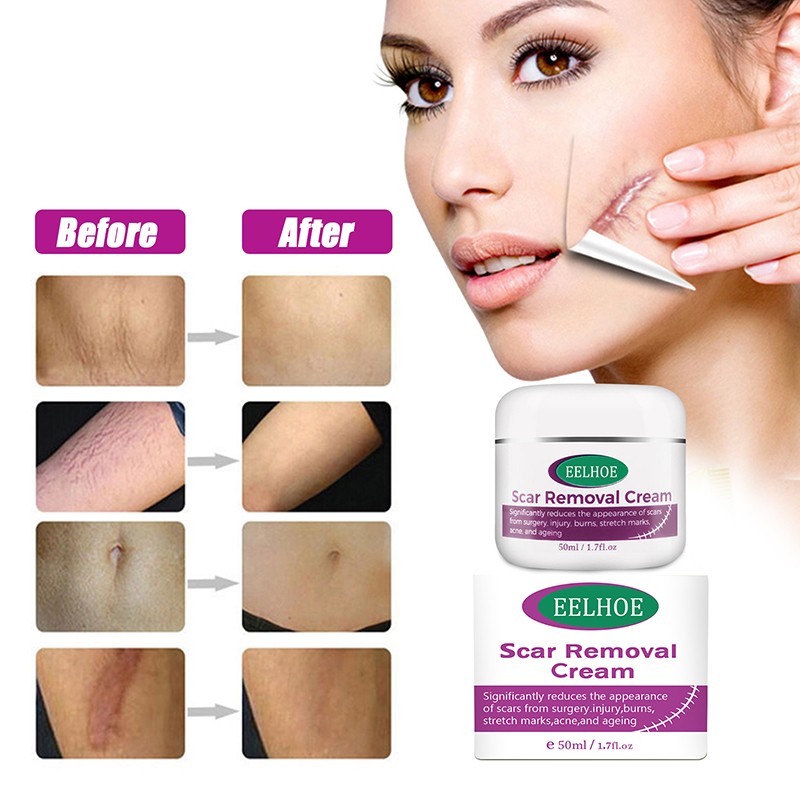 Moon Bevy Skin Removal Cream 50ml Acne Scar Remover For Women Anti Aging Cream For Body Care