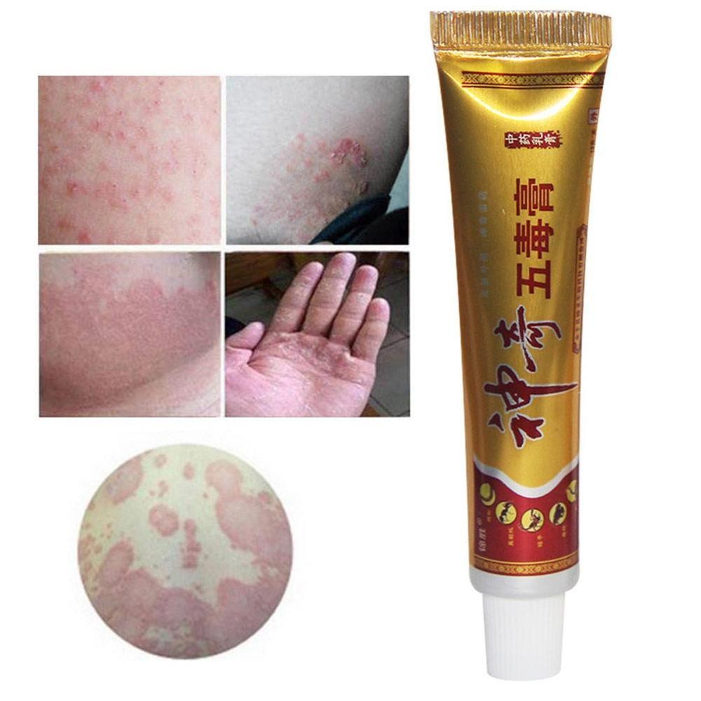 YIGANERJING Useful Psoriasis Cream Psoriasis Ointment Eczematoid Dermatitis Ointment Moisturizing Skin Cream