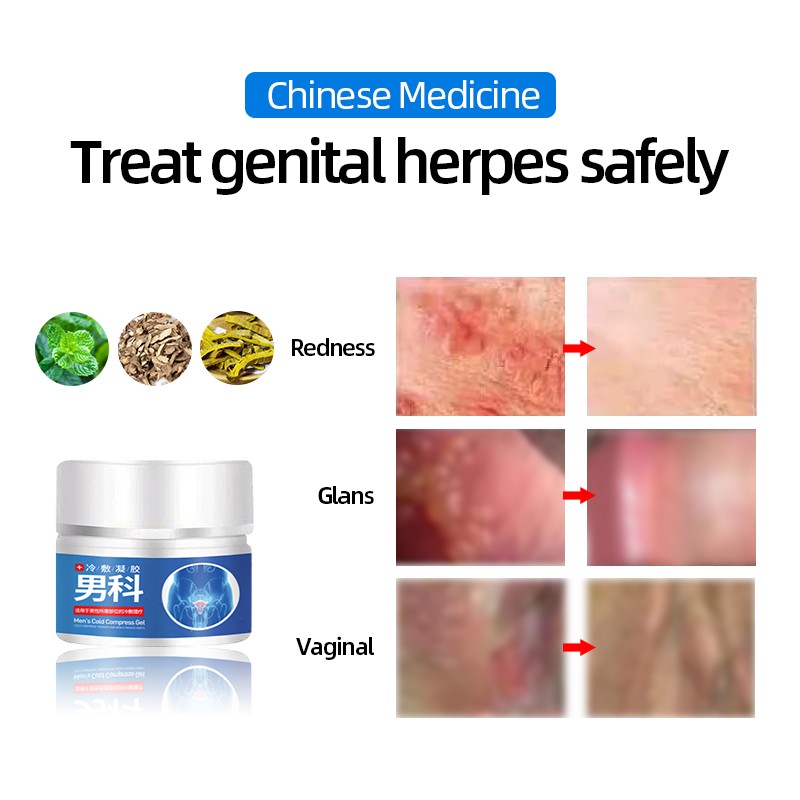 Male Genital Herpes Medicine Cream Genital Treatment Men Balanitis Antibacterial Anti-burn Odor Removal Treatment Herpes Zoster