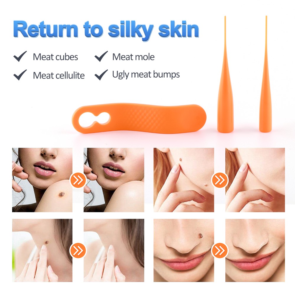 Dermal Removal Kit 2 in 1 Skin Tag Removal Micro Band 4-6mm For Papillomas Berrugas Warts Mole Removal Wart Face Care