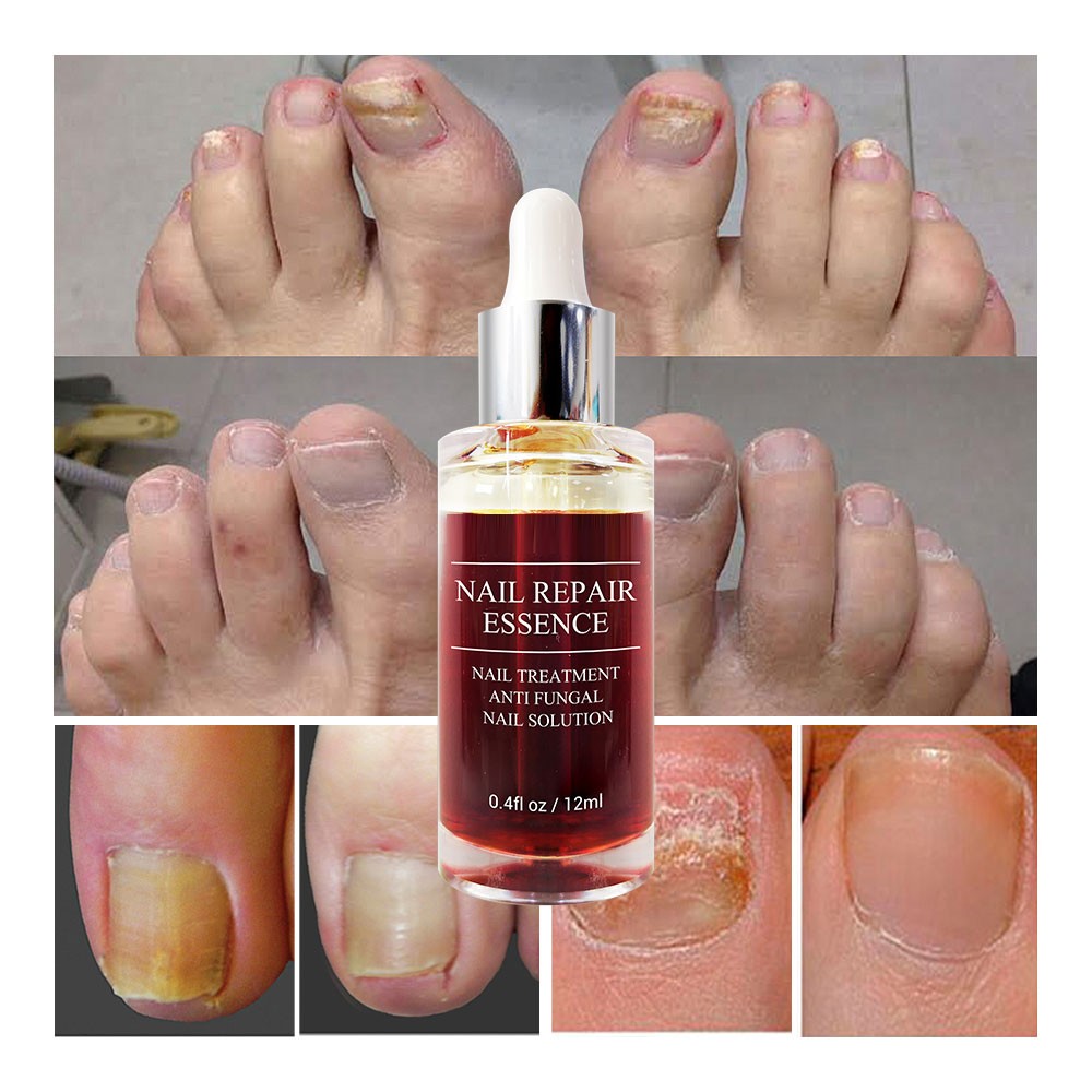 LANBENA - Fungus repair serum, nail care treatment, anti-infective gel, paronychia, onychomycosis