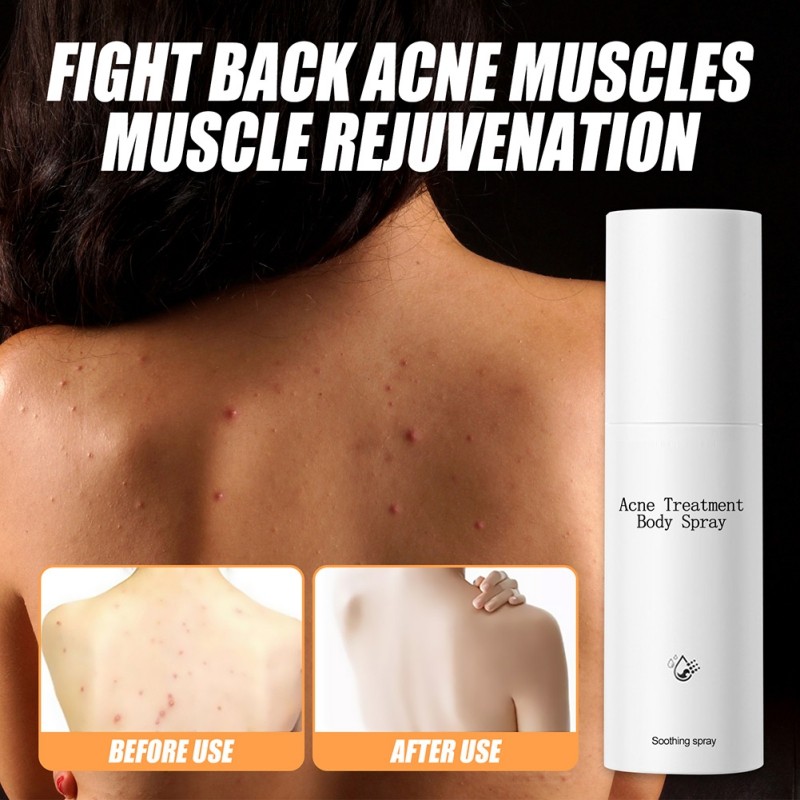 Acne Body Spray 100ml Body Chest Butt Back Acne External Use Multiple Daily Uses For All Skin Types Acne Treatment