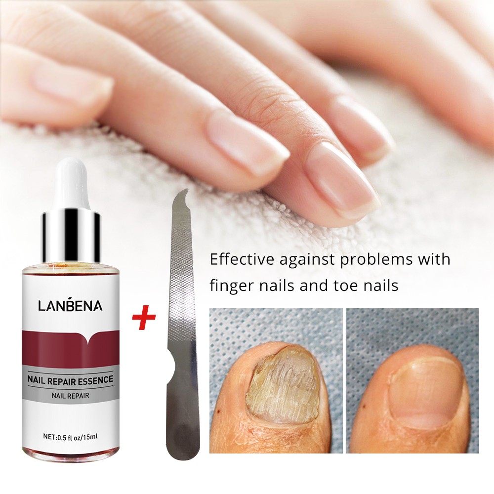 Nail Fungal Treatment Essence Foot Toe Nail Fungus Removal Gel Anti Infection Paronychia Nails Nail Repair