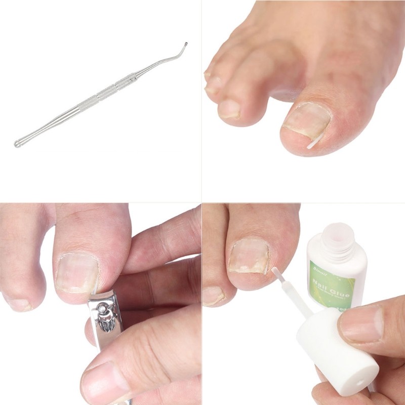 10pcs/set Ingrown Toenail Correction Tool Pain Care Ingrowing Nail Corrector Used For Home