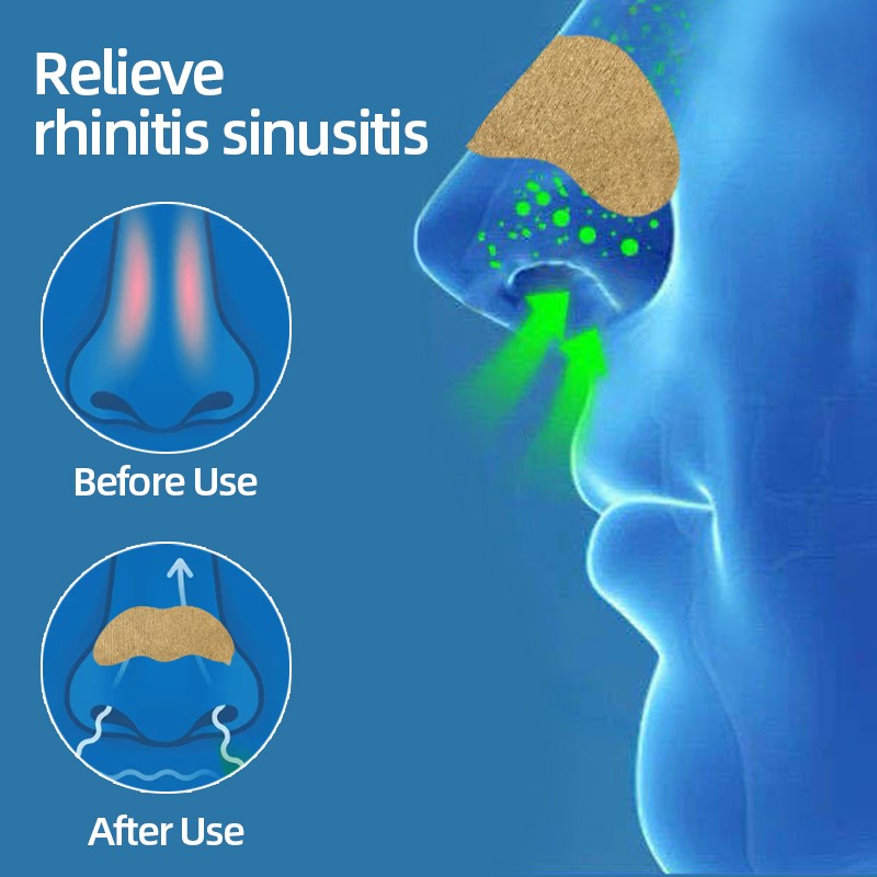 6/12/18/24pcs Rhinitis Allergy Reliever Patch Sinusitis Medical Treatment Nasal Strips Nasal Congestion Sneezing Cure