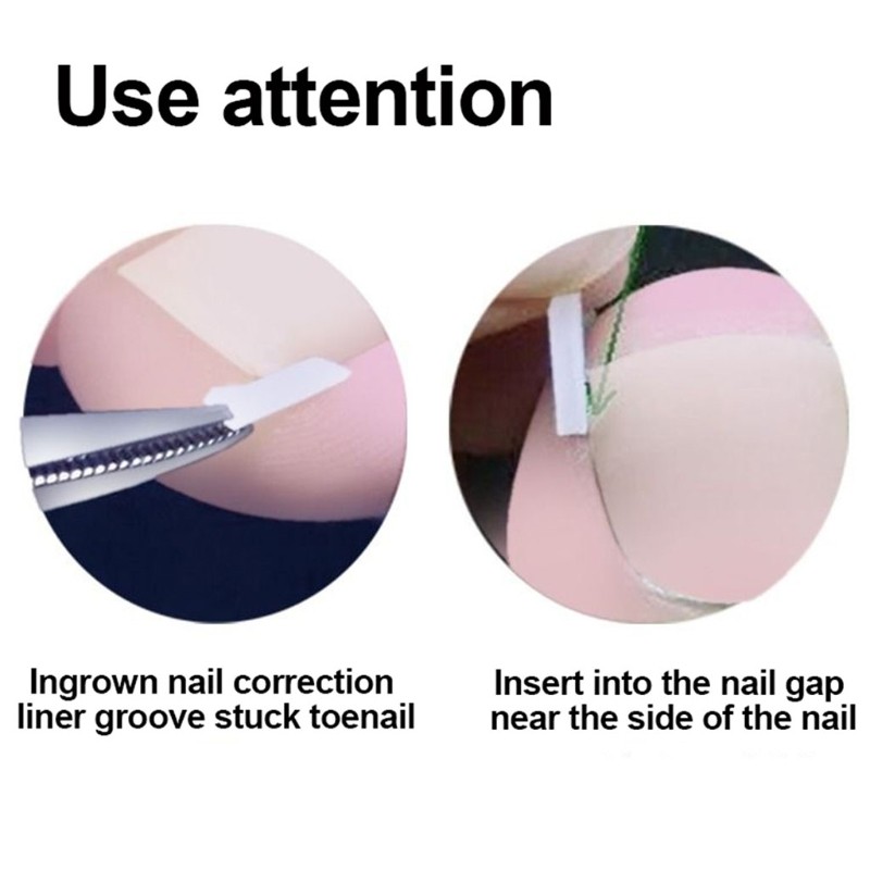 10pcs/set Ingrown Toenail Correction Tool Pain Care Ingrowing Nail Corrector Used For Home