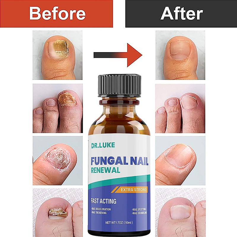 50ml Nail Repair Extract Anti Fungal Nail Treatment Remove Mycosis Nourishing Brighten Hand Foot Toes Nail Care