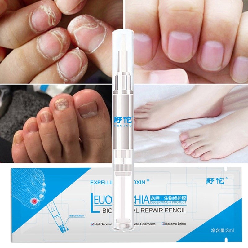 3ml Nail Repair Liquid Pen With Brush Cute Anti Fungus Remover Onychomycosis Paronychia Foot Nail Fungus For Nails Manicure