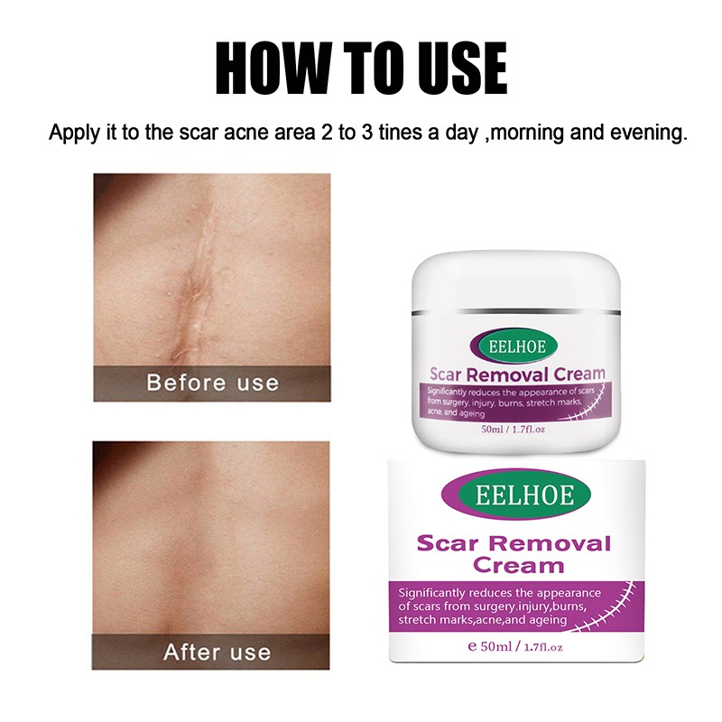 Moon Bevy Skin Removal Cream 50ml Acne Scar Remover For Women Anti Aging Cream For Body Care