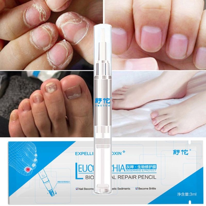 Fungal Nail Pen, 3ml, Effective, Onychomycosis, Paronychia, Anti-infection, Fungi, Repair Solution, Toenail Treatment Gel, Nourishing Essence