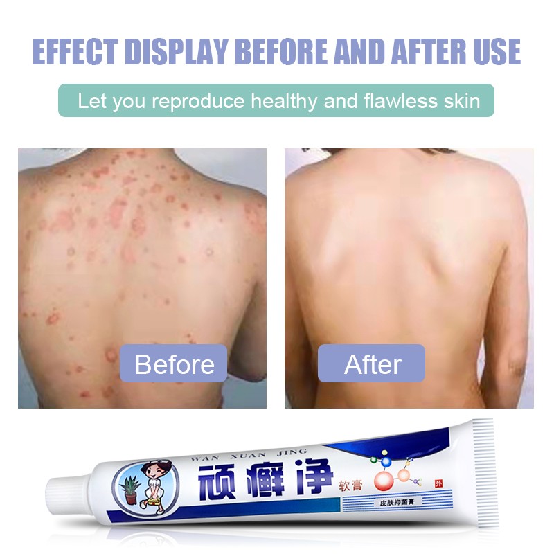 2pcs Psoriasis Cream Dermatitis Eczema Ointment Treatment Scaly Plaques Psoriasis Tina Pedis Relieve Itch Skin Care Cream A256