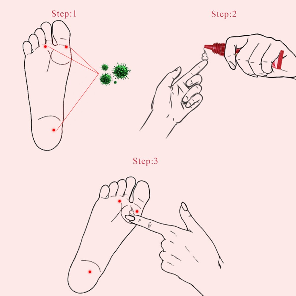 Effective Herbal Foot Cream Treatment Anti Fungal Infection Paronychia Gel Treatment Toe Fungus Repair Dry Gel Detox Spa