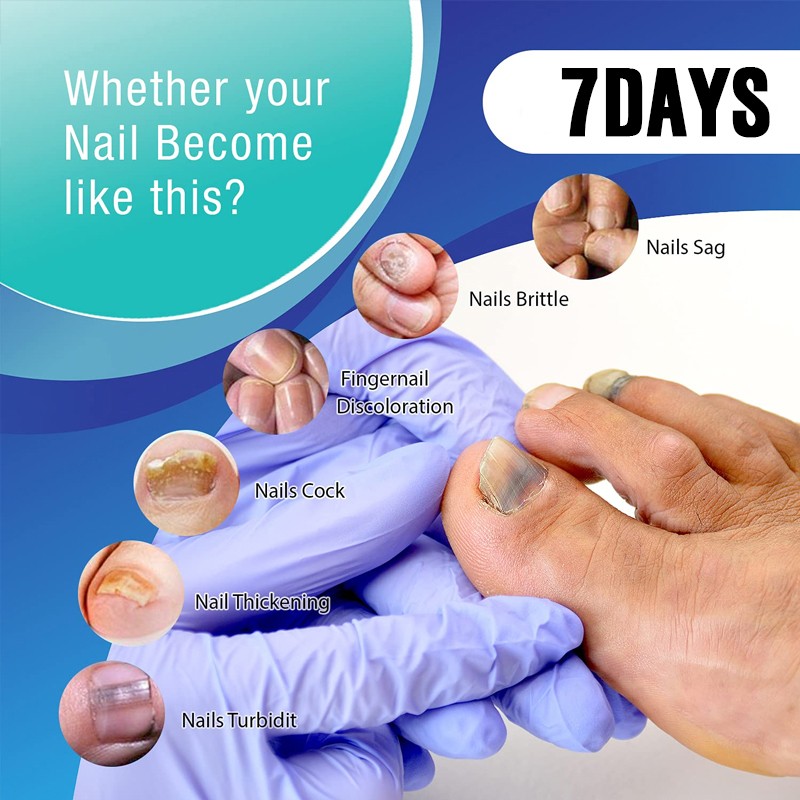 Nail Repair Serum Nail Fungal Treatment Serum Toenail Fungus Treatment Device Antifungal Toe Fungus Treatment Foot Repair Care