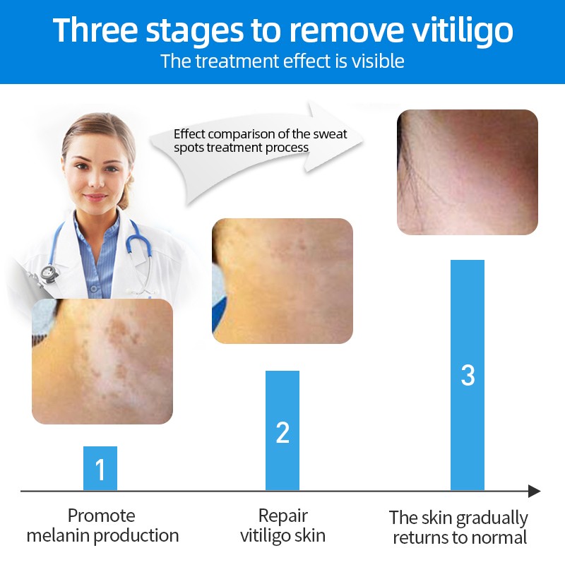 Chinese Medical Vitiligo Antibacterial Hand Spray White Spot Repair Liquid Foot Disease Leukoplakia Promote Melanin