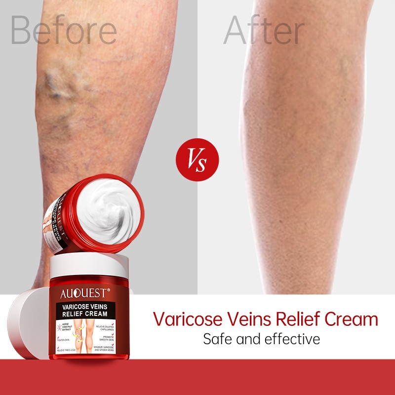 AUQUEST Varicose Veins Relief Cream Vasculitis Spider Pain Relief Ointment Medical Plaster Body Care 80g