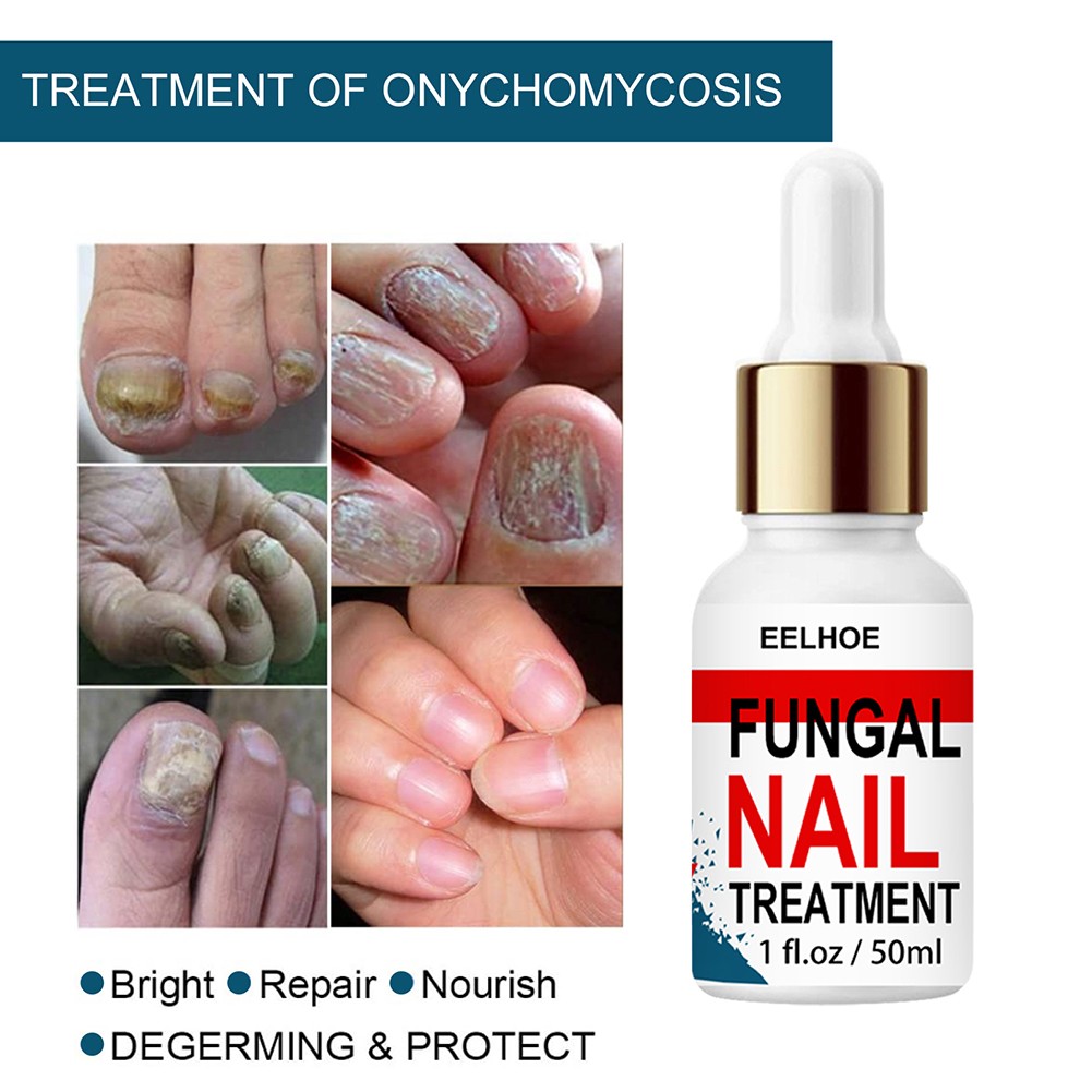 50ml Nail Repair Extract Anti Fungal Nail Treatment Remove Mycosis Nourishing Brighten Hand Foot Toes Nail Care