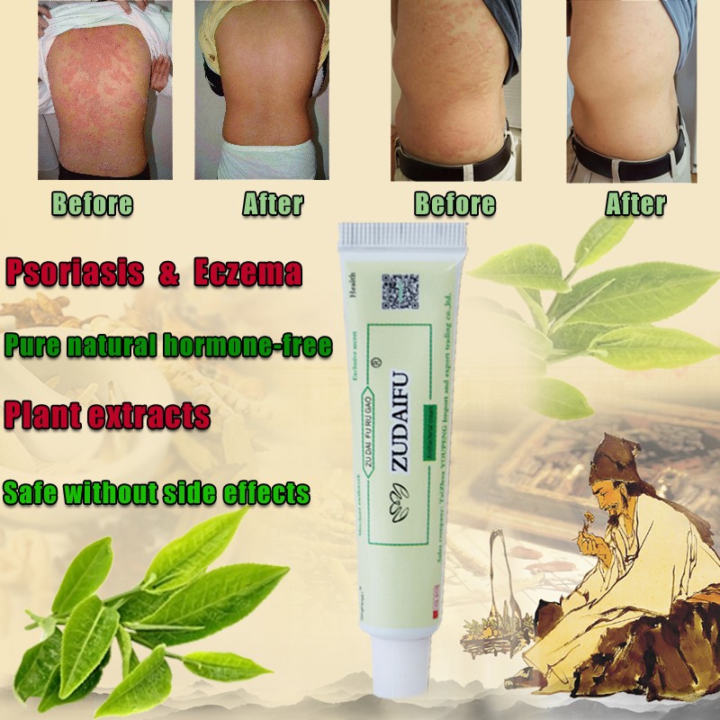 Zudaifu Psoriasis Skin Dermatitis Cream Eczematoid Cream Allergy Treatment Neurodermatitis Psoriasis Eczema Ointment Dropship