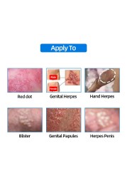 Male Genital Herpes Medicine Cream Genital Treatment Men Balanitis Antibacterial Anti-burn Odor Removal Treatment Herpes Zoster
