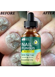 Nail Fungus Treatment Feet Care Nail Essence Repair Foot Toe Nail Fungus Removal Gel Anti Infection Paronychia Onychomycosis