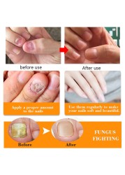 50ml Nail Repair Essence Serum Anti Fungal Nail Treatment Remove Onychomycosis Nourishing Brighten Hand Foot Toes Nail Care