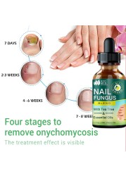 Nail Fungus Treatment Feet Care Nail Essence Repair Foot Toe Nail Fungus Removal Gel Anti Infection Paronychia Onychomycosis