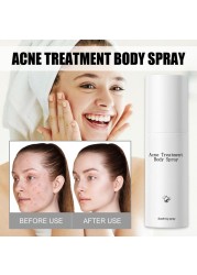 Acne Body Spray 100ml Body Chest Butt Back Acne External Use Multiple Daily Uses For All Skin Types Acne Treatment