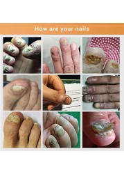 Nail Fungal Treatment Essence Foot Toe Nail Fungus Removal Gel Anti Infection Paronychia Nails Nail Repair