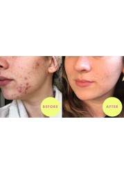 Eritretin Acne Face and Skin Treatment for Acne Prone Skin Cystic Acne, Advanced Acne Remover, Fast Acting