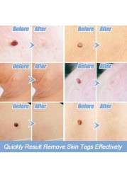 Warts & Warts Removal Kit Skin Tag Killing Skin Moles Fine Skin Tag With Cleansing Adult Warts Face Care