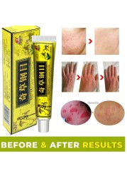 Bian Chicao Bing Skin Psoriasis Cream 999 Ointment of Psoriasis Psoriasis Treatment Relief Various Skin Problem