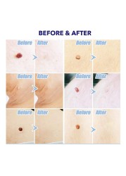 Lescolton Skin Tag Removal Kit Painless Skin Wart Removal Body Face Neck Skin Skin Cleansing Home Use