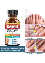 Nail Repair Serum Nail Fungal Treatment Serum Onychomycosis Paronychia Anti-Fungal Nail Infection Toe Fungus Foot Repair Care