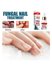 50ml Nail Repair Extract Anti Fungal Nail Treatment Remove Mycosis Nourishing Brighten Hand Foot Toes Nail Care