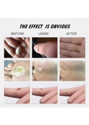 Foot Care Callus Peeling Pads Corn Removal Medical Warts Thorn Treatment Cream Calluses Dead Skin Remover Exfoliating Pedicure