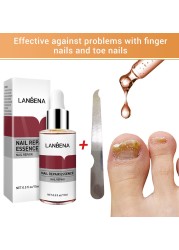 Nail Fungal Treatment Essence Foot Toe Nail Fungus Removal Gel Anti Infection Paronychia Nails Nail Repair